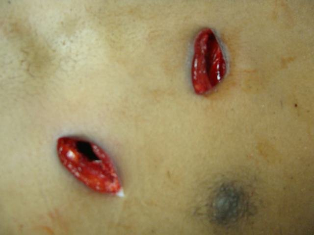 Stab wound Bewelling