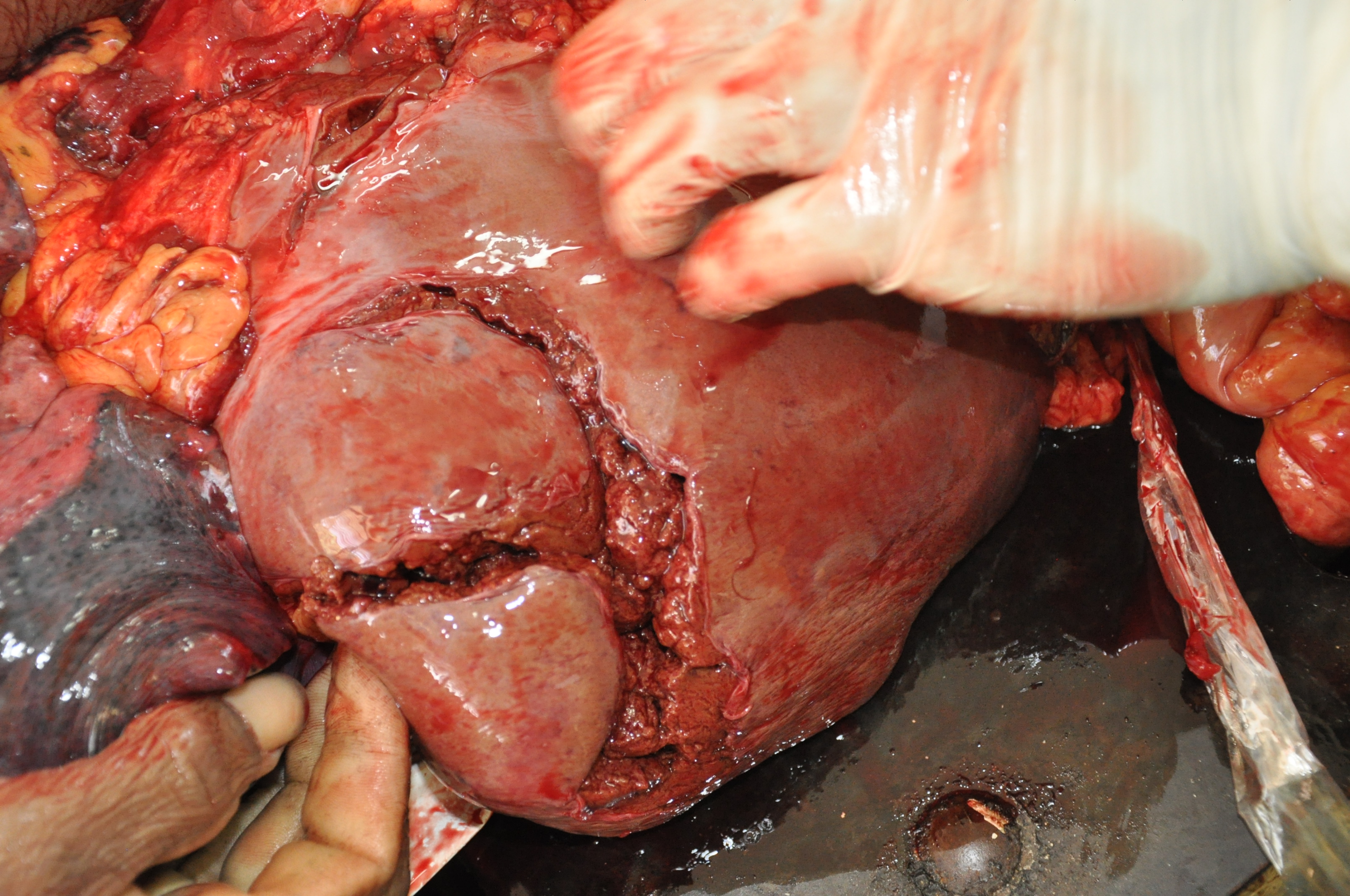 Blunt Force Injuries 1