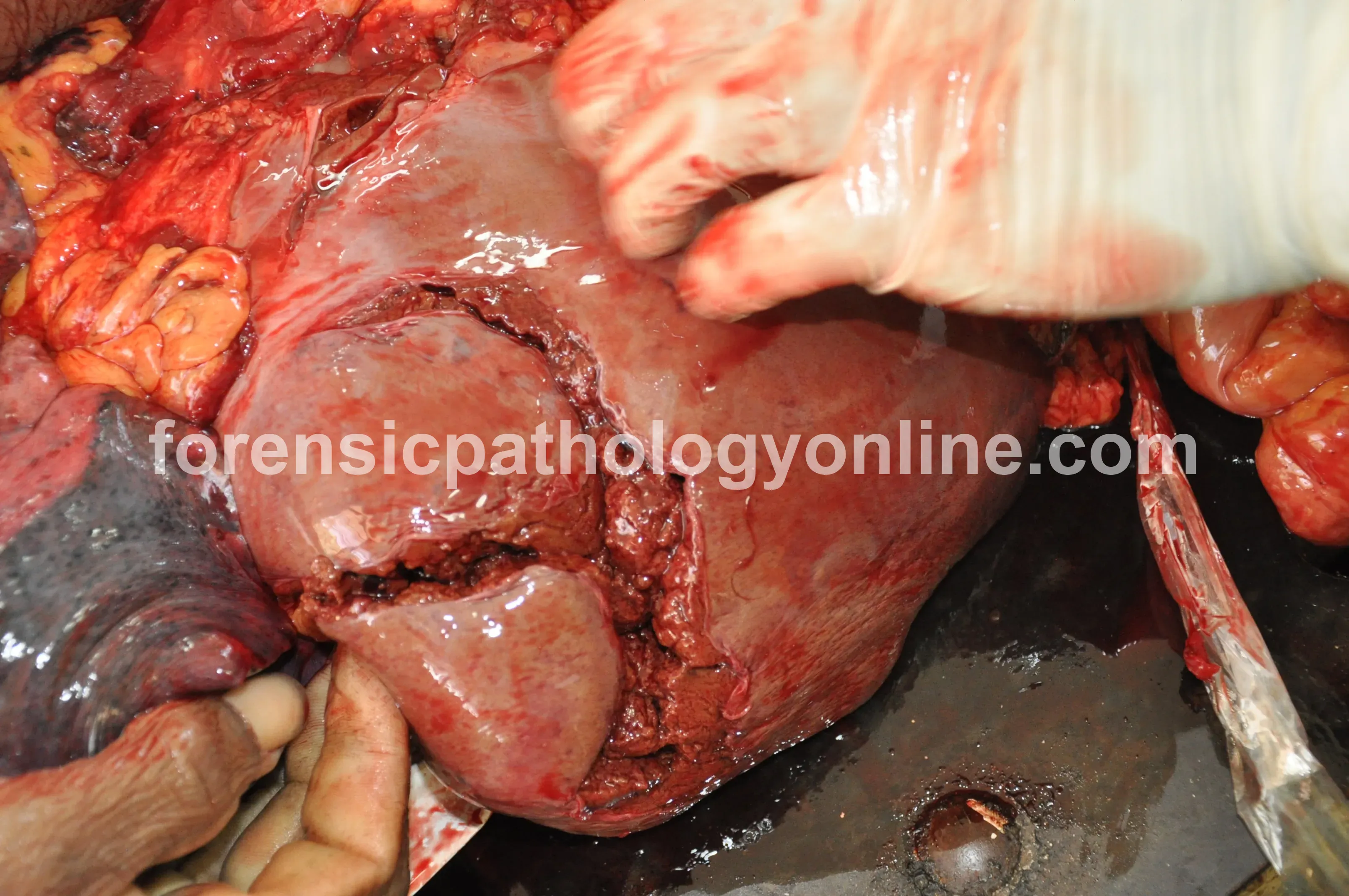 Blunt Force Injuries 1