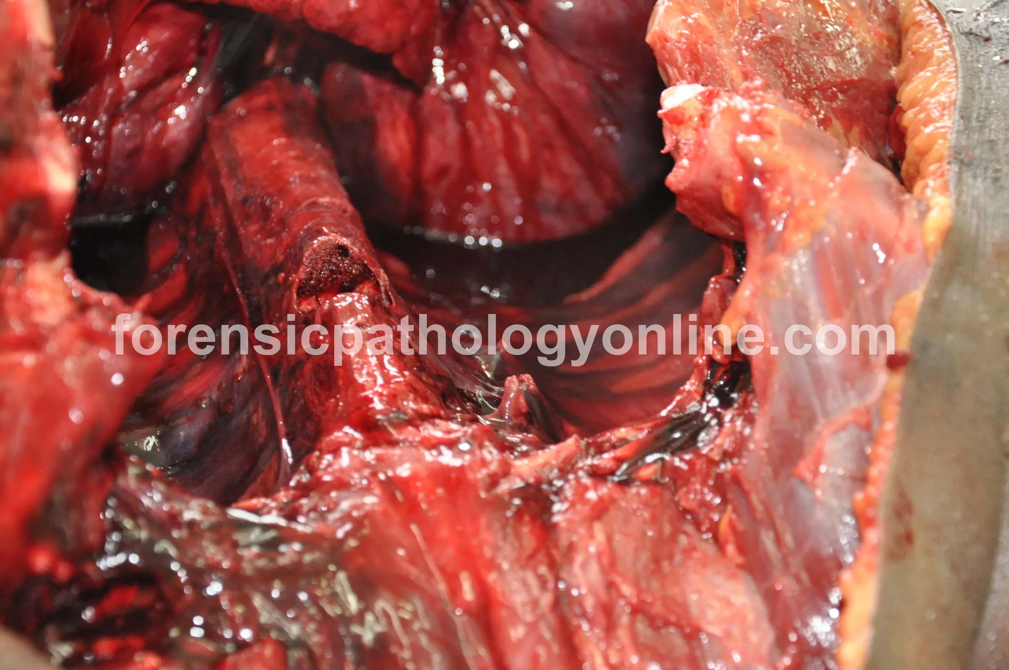 Blunt Force Injuries 10