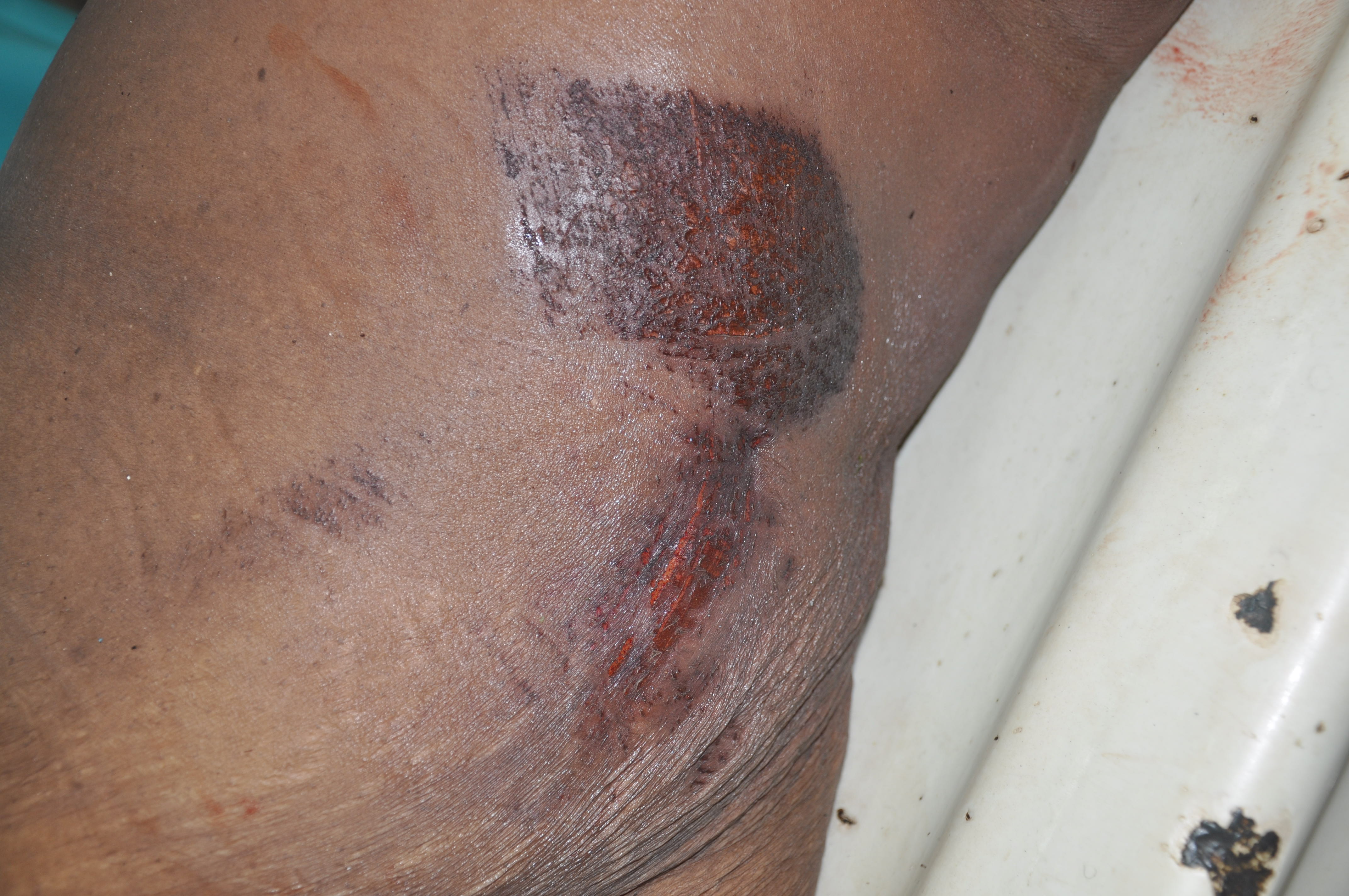 Blunt Force Injuries 11