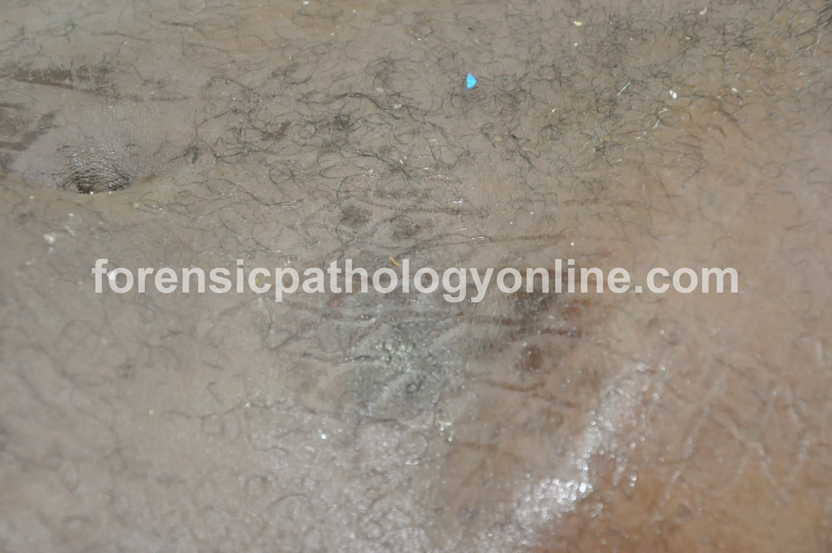 Blunt Force Injuries 2