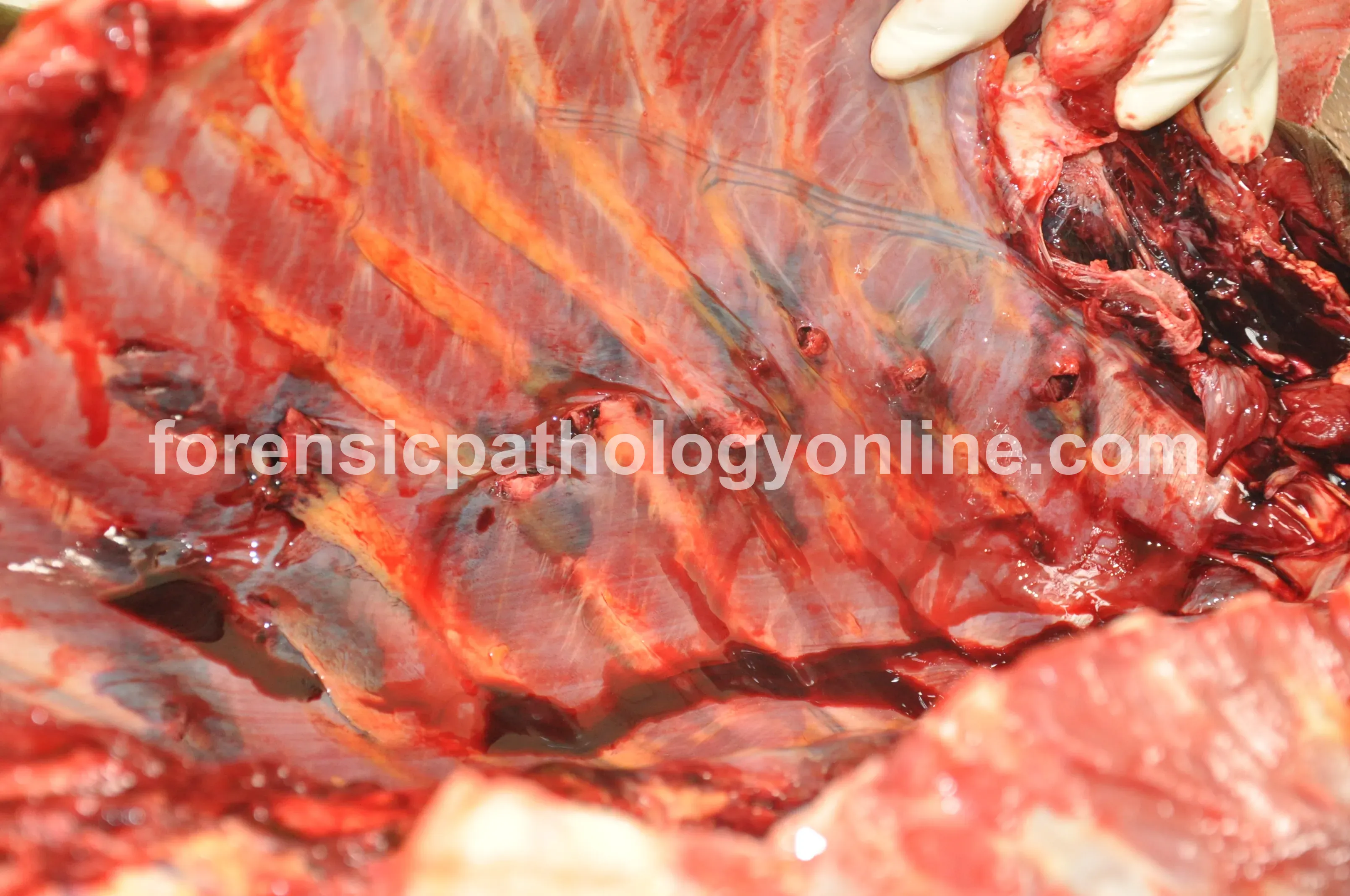 Blunt Force Injuries 3