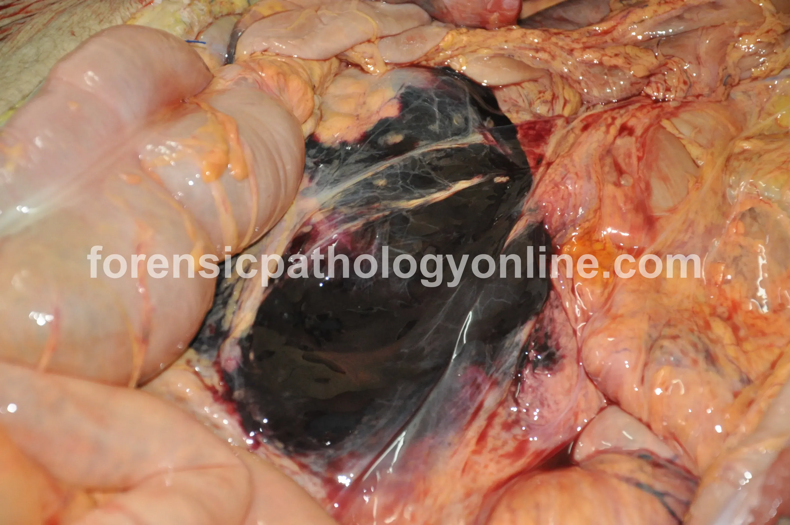 Blunt Force Injuries 4