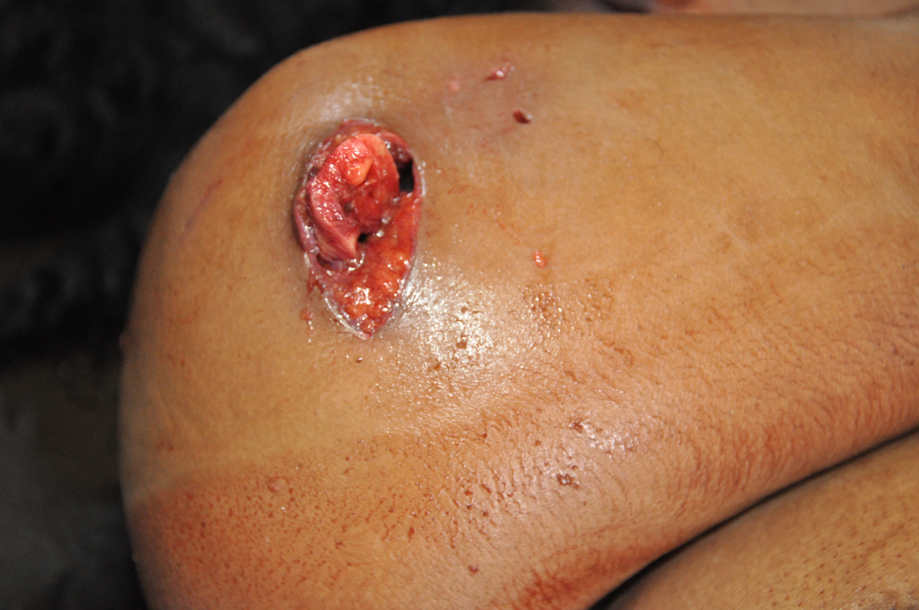 Blunt Force Injuries 6