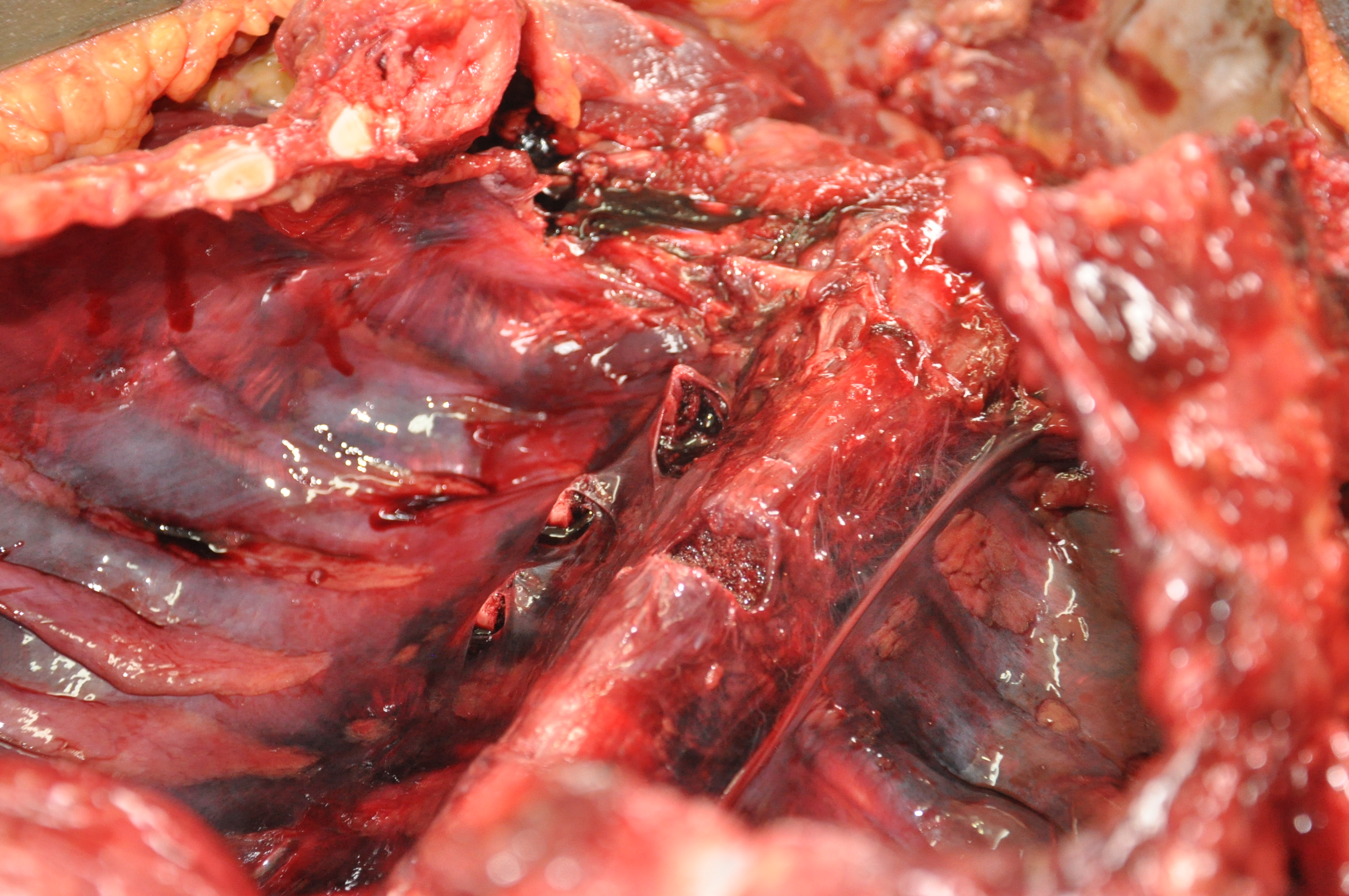 Blunt Force Injuries 7