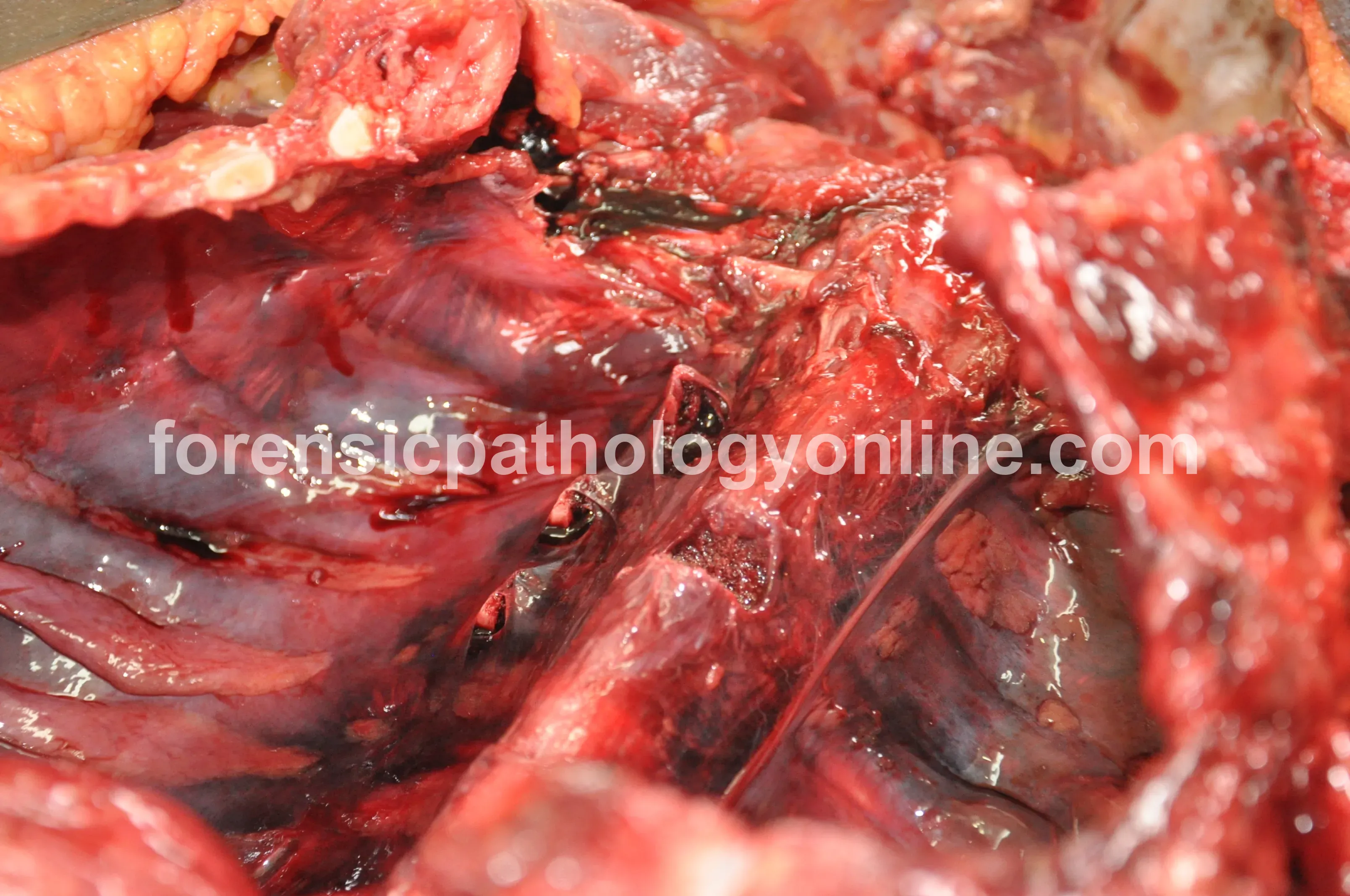 Blunt Force Injuries 7