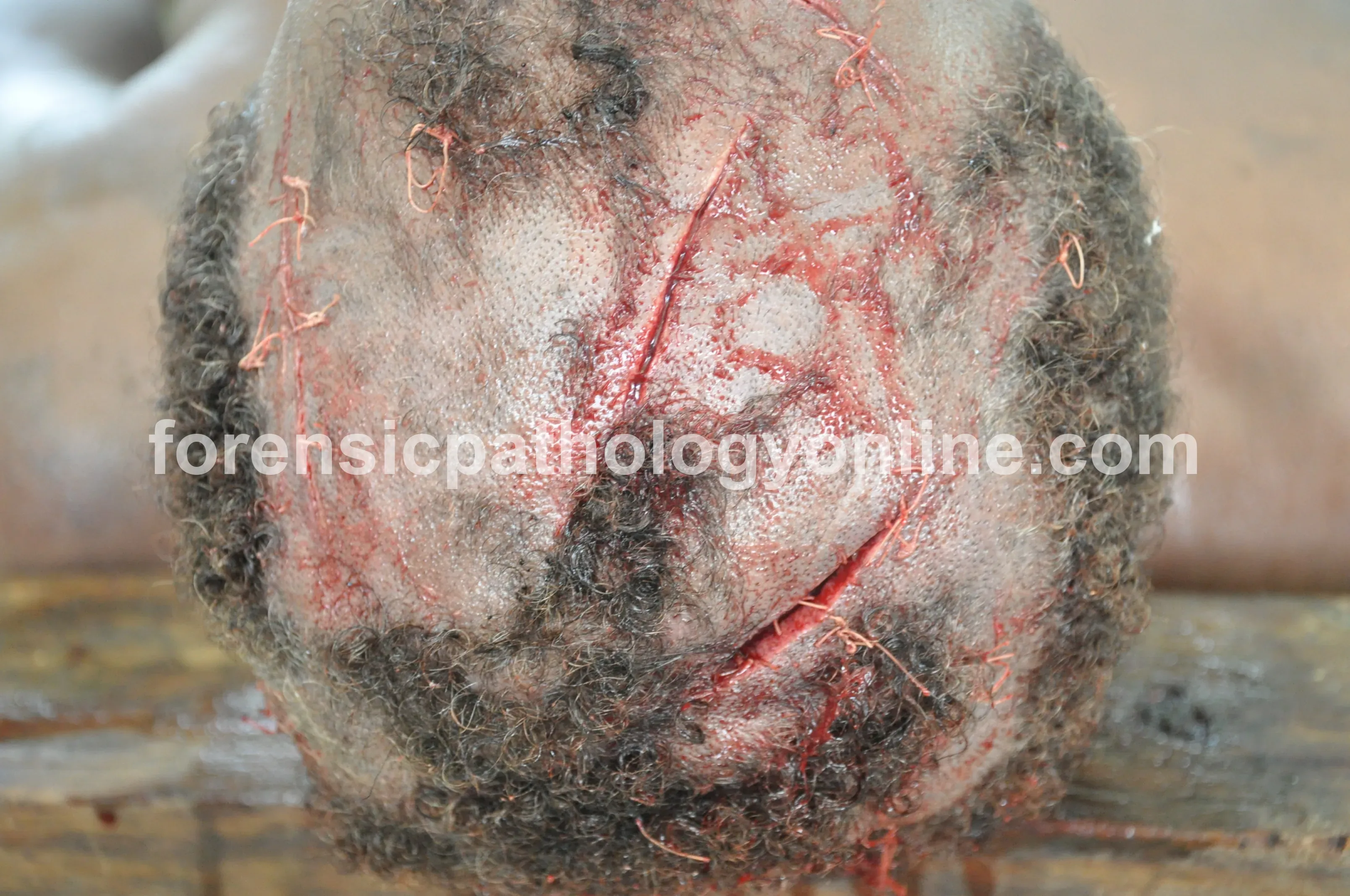 Sharp Force Injuries 2