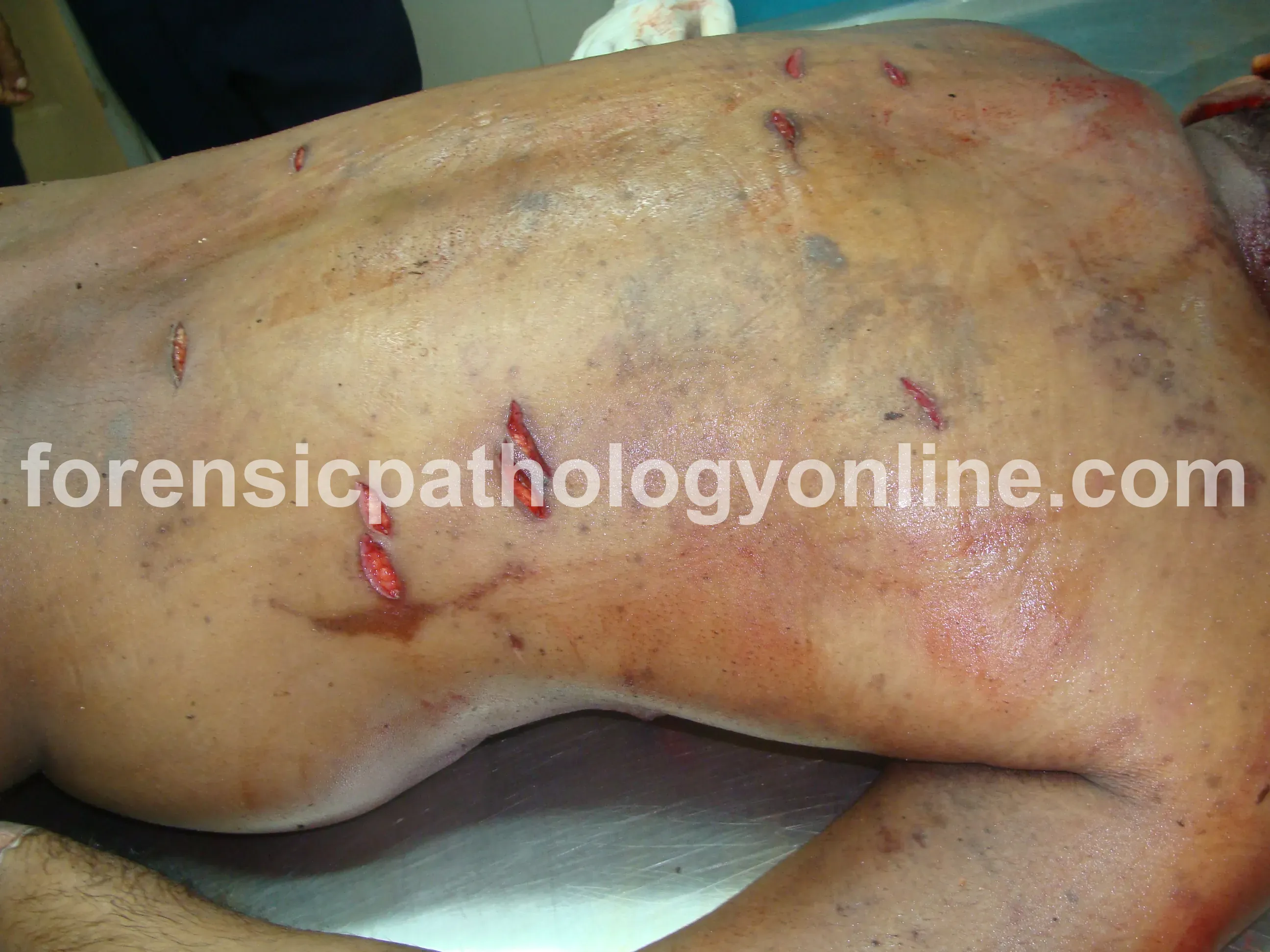 Sharp Force Injuries 3