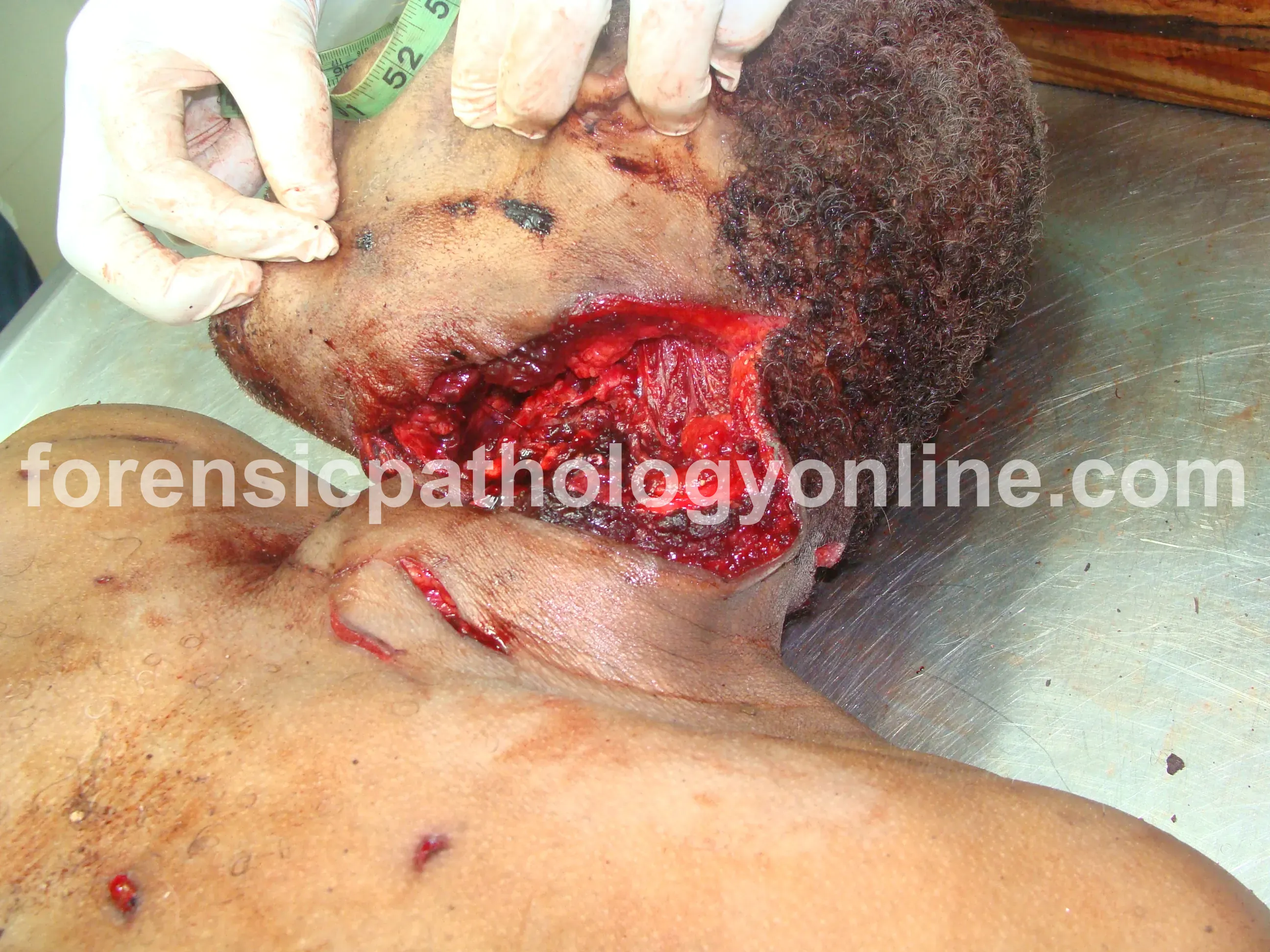 Sharp Force Injuries 4