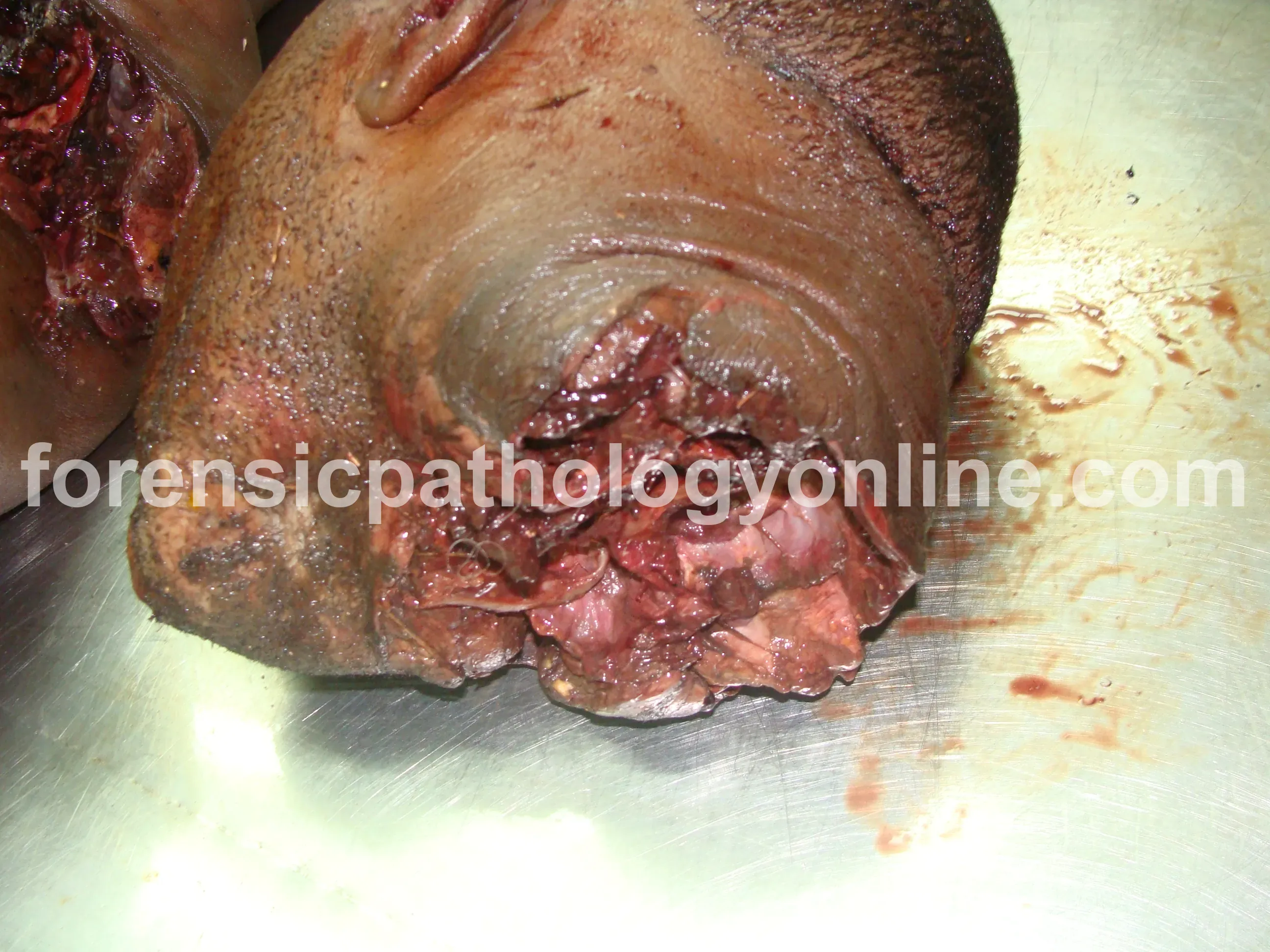 Sharp Force Injuries 5