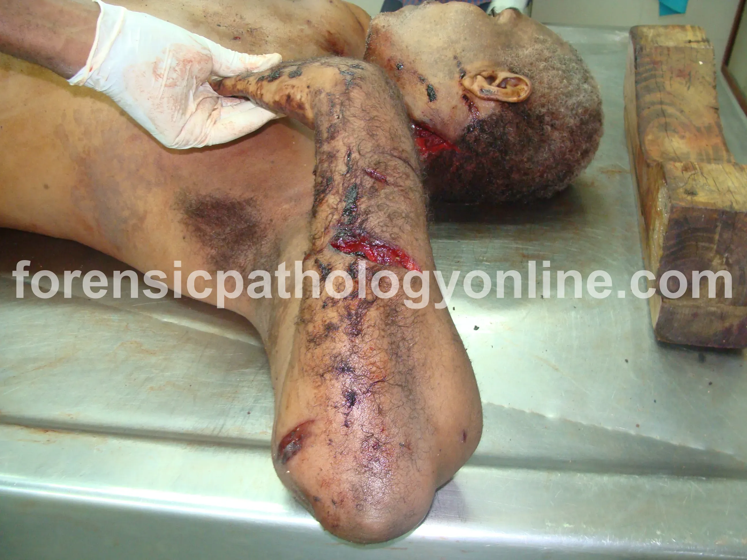 Sharp Force Injuries 7