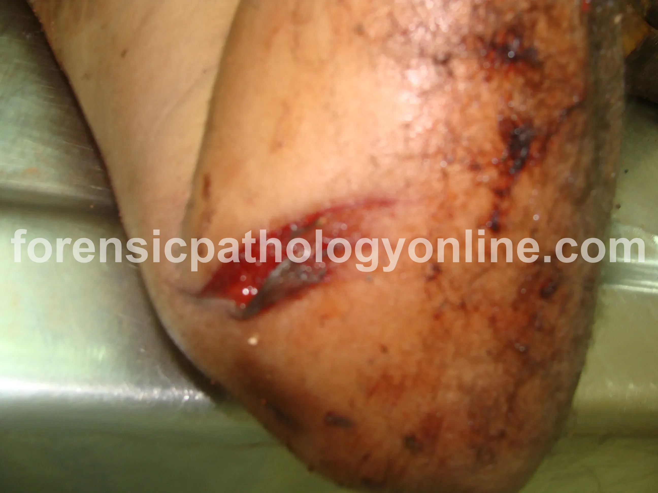 Sharp Force Injuries 8